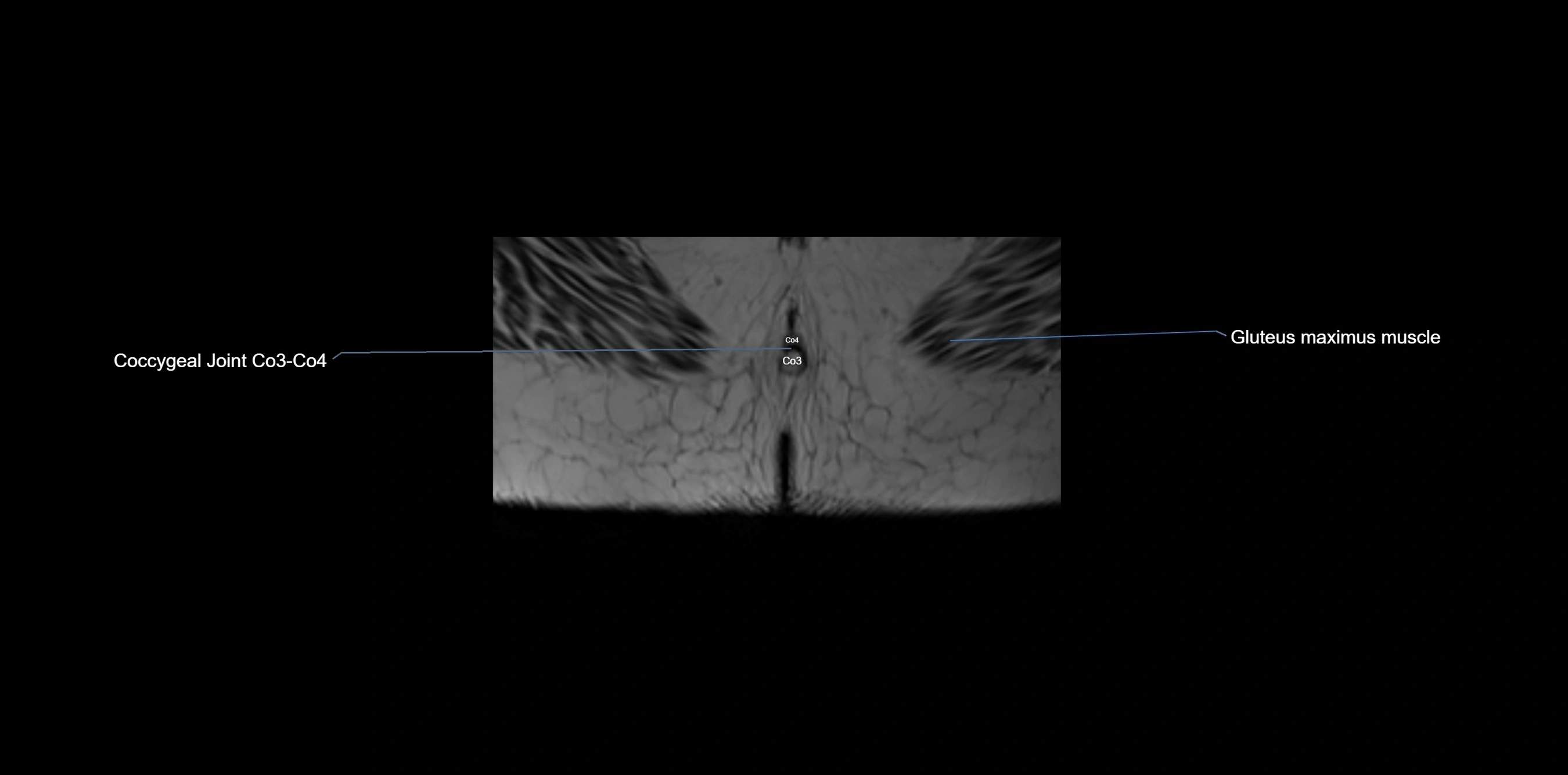 MRI sacrum, coccyx and sacroiliac joint axial cross sectional anatomy 3T  radiology  image-img-00001-00083.webp